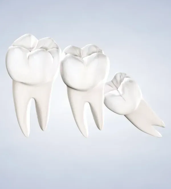 Wisdom Teeth Removal
