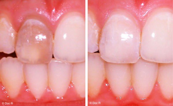 Einzelzahnaufhellung: Aufhellung (Bleaching) einzelner toter Zähne