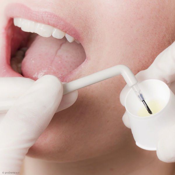 Fluoridierung zur Zahnschmelzhärtung: Schutz vor Karies