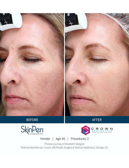 Microneedling Treatment Before and After — Bryant, AR — Practical Wellness Clinic