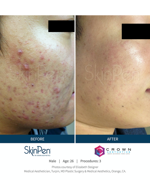 SkinPen MicroNeedling Before and After — Bryant, AR — Practical Wellness Clinic