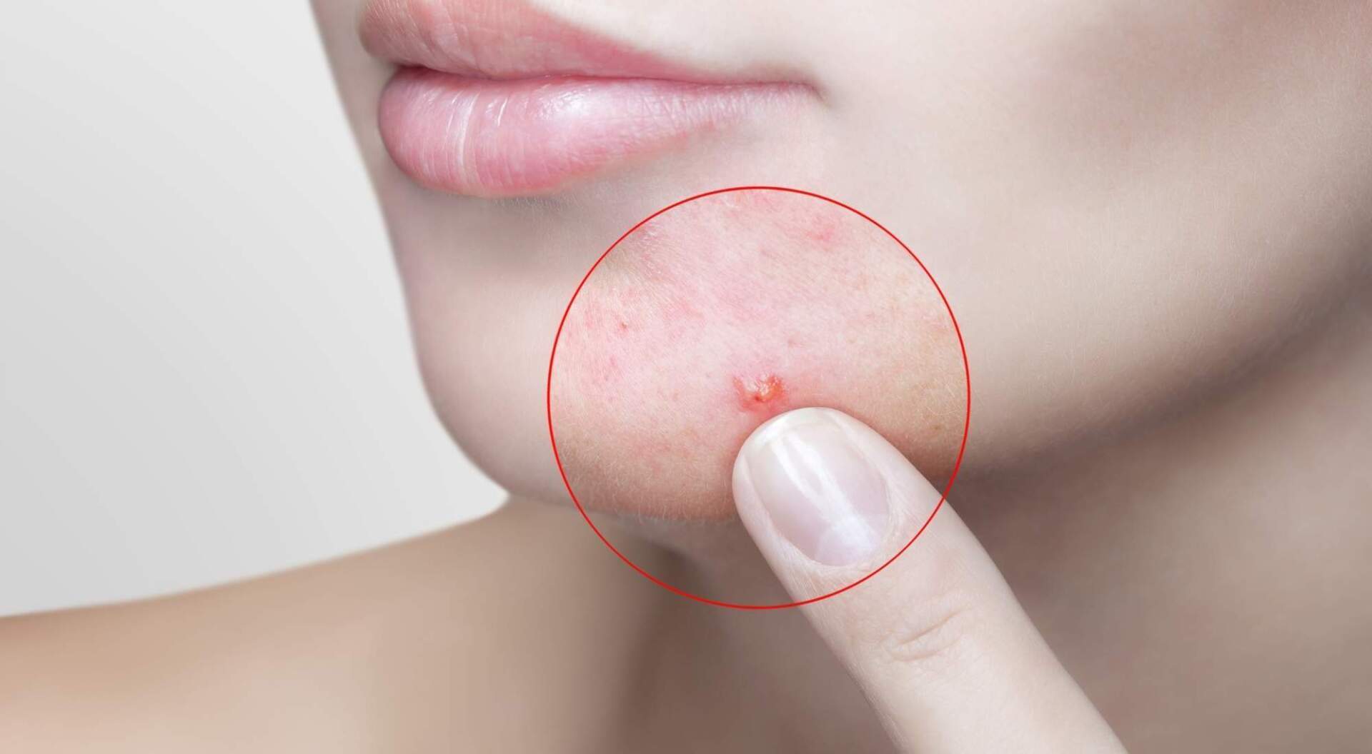 can food allergies cause cystic acne