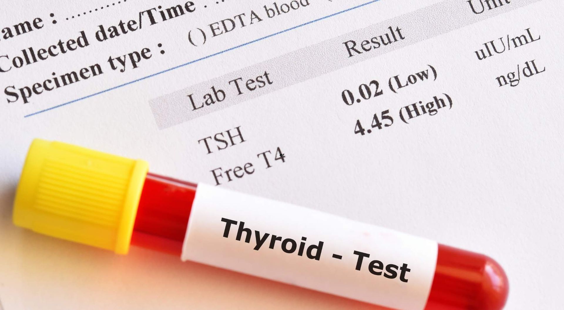 can you have hypothyroidsim with a normal tsh level