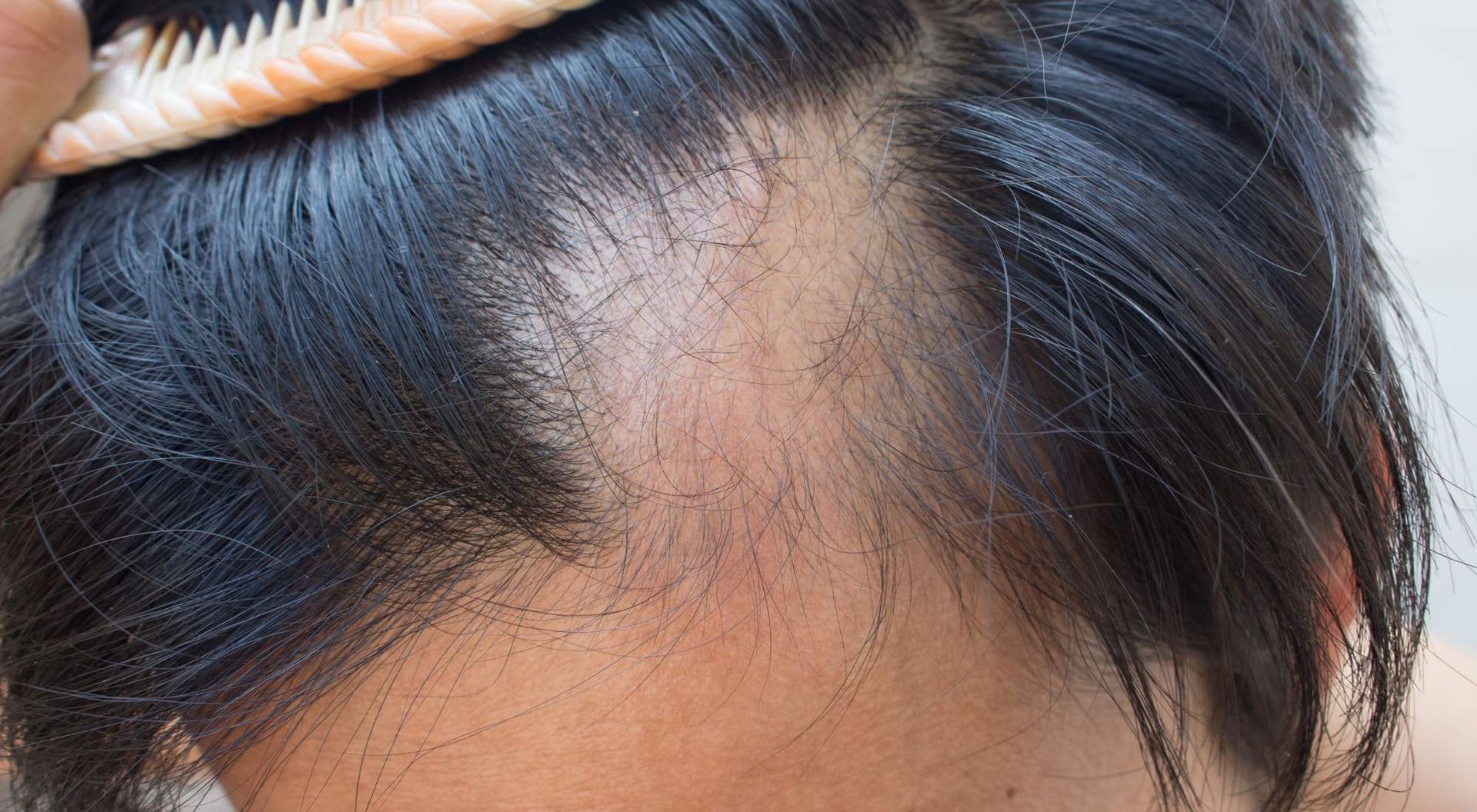 how does hypothyroidism cause hair loss