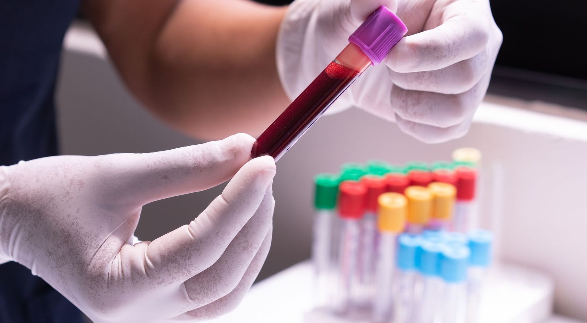 can hypothroidism cause elevated alt and ast