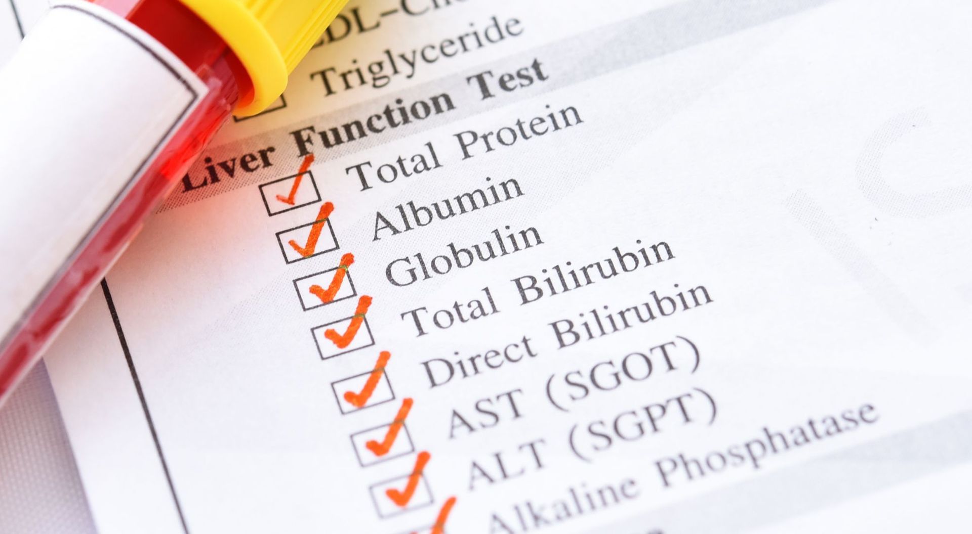 can hypothroidism cause elevated alt and ast