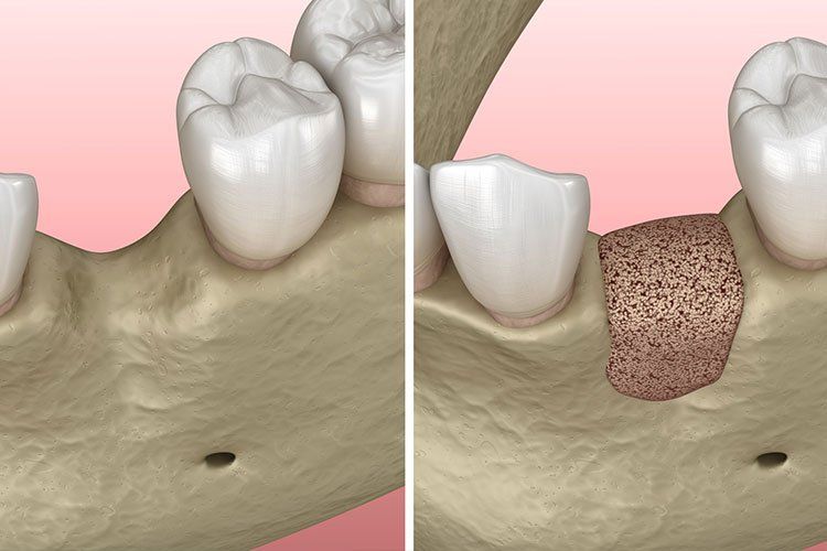 bone and gum graft model