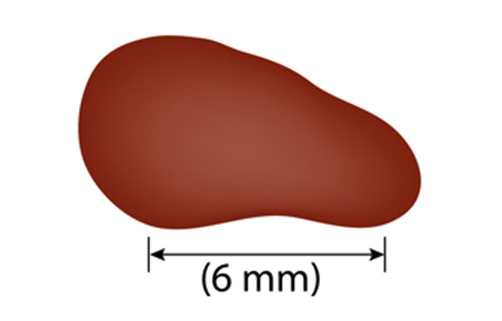 Diameter (greater than 6mm)