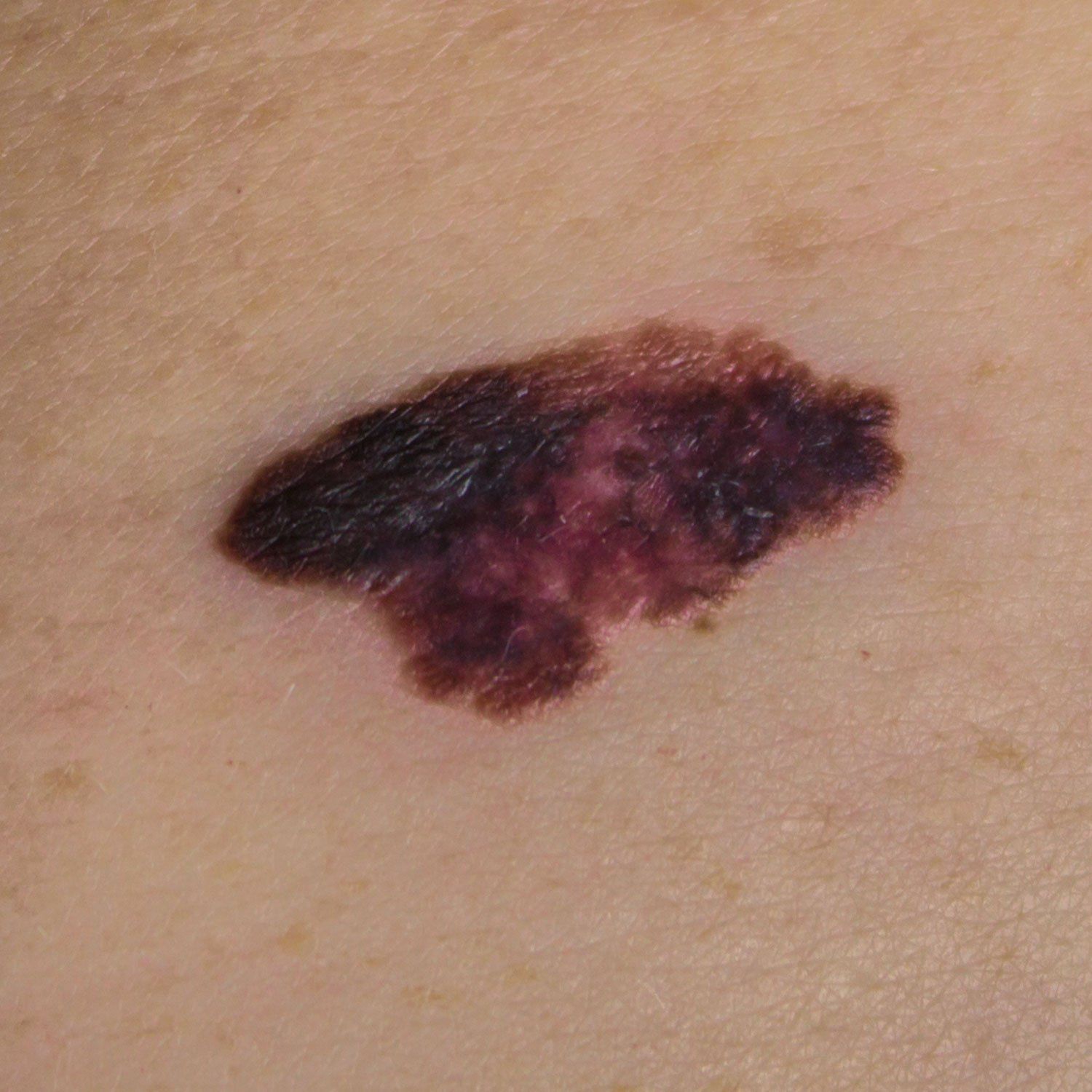 Melanoma