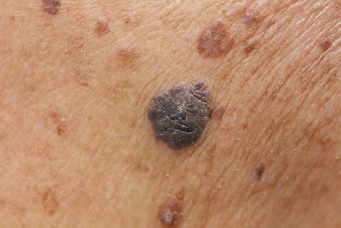 Suspicious Mole on Skin - Moles in Bountiful, UT