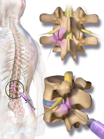 Relief for Your Sciatic Nerve Pain: Apollo Pain Management: Interventional  Pain Management Specialists