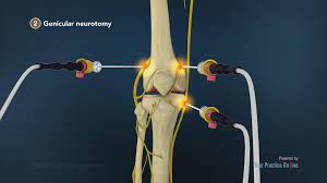 treating knee pain