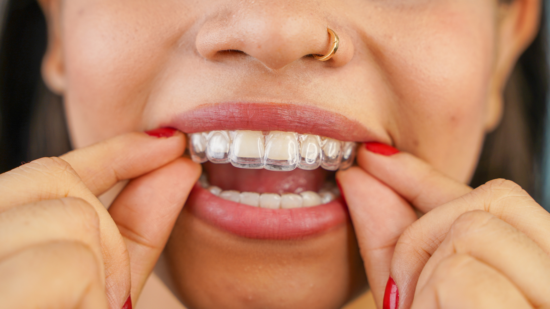 Person inserts clear aligner into mouth, lips parted, revealing teeth. Hands visible with red nail polish.