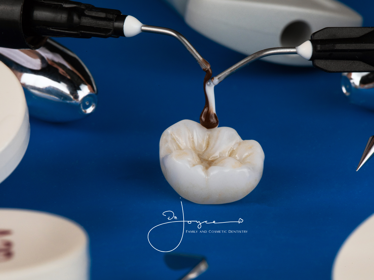 What Are Dental Inlays and Onlays? Do you need them?