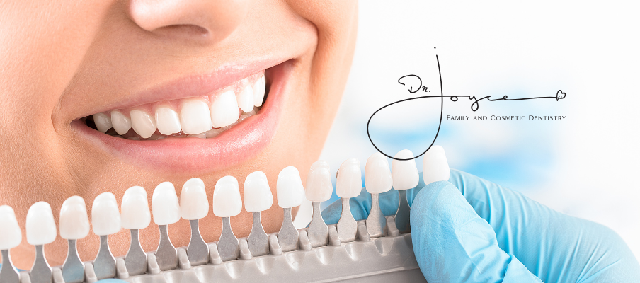 Is It Worth It to Get Your Teeth Professionally Whitened?