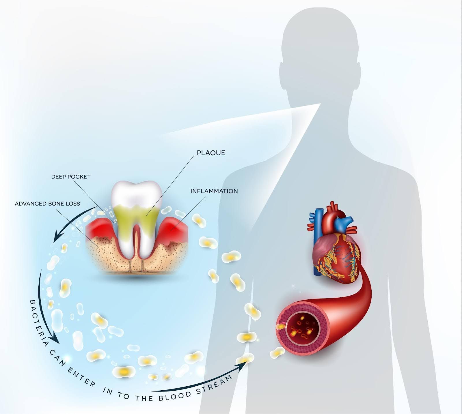 Diagram showing how bacteria from gum disease can enter the bloodstream and affect the heart.