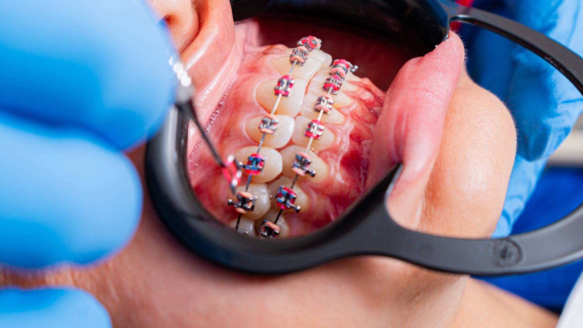 Close-up of teeth with braces being adjusted by a dentist wearing blue gloves and black magnifier glasses
