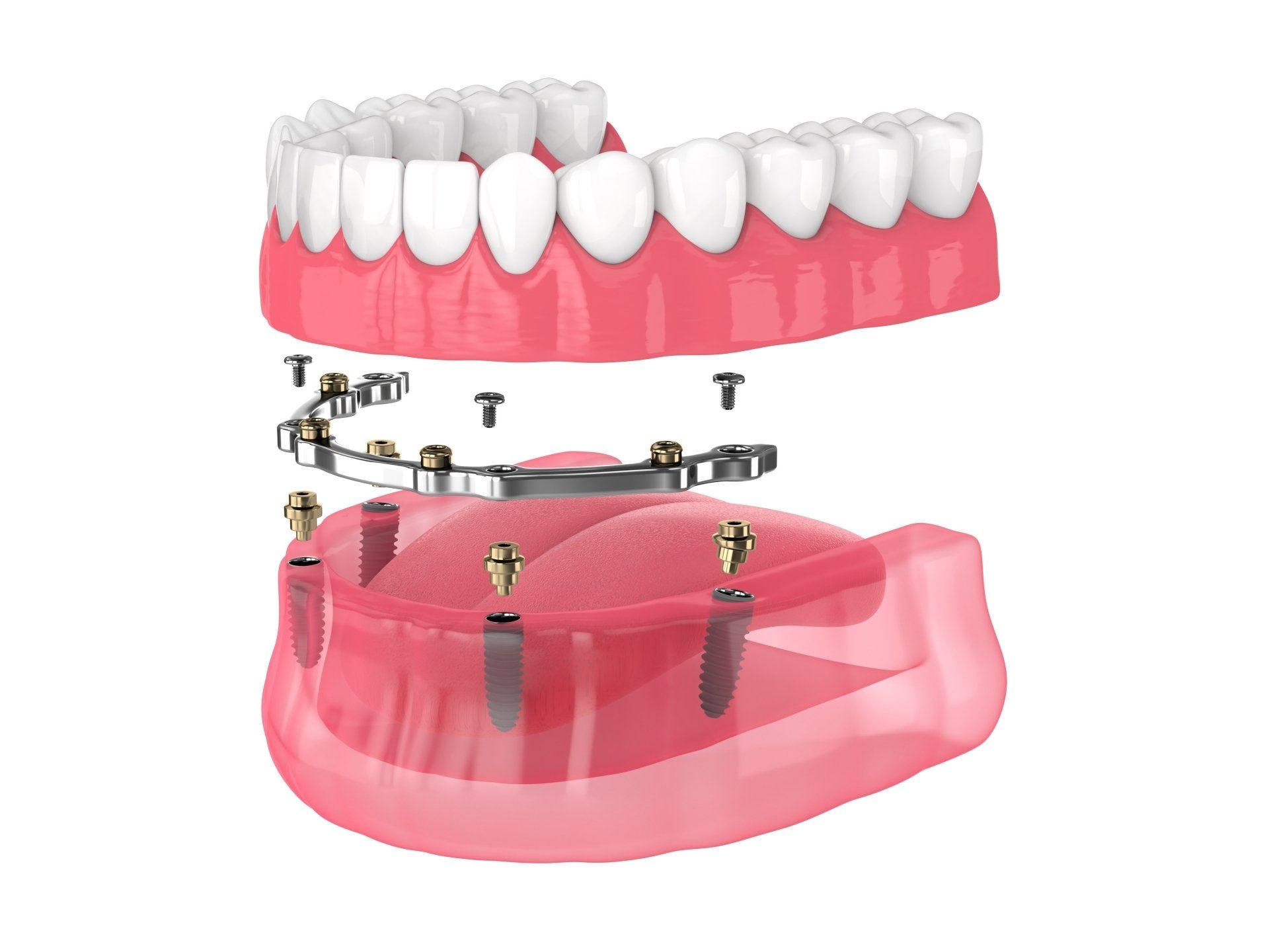 A 3d rendering of a full denture with dental implants.