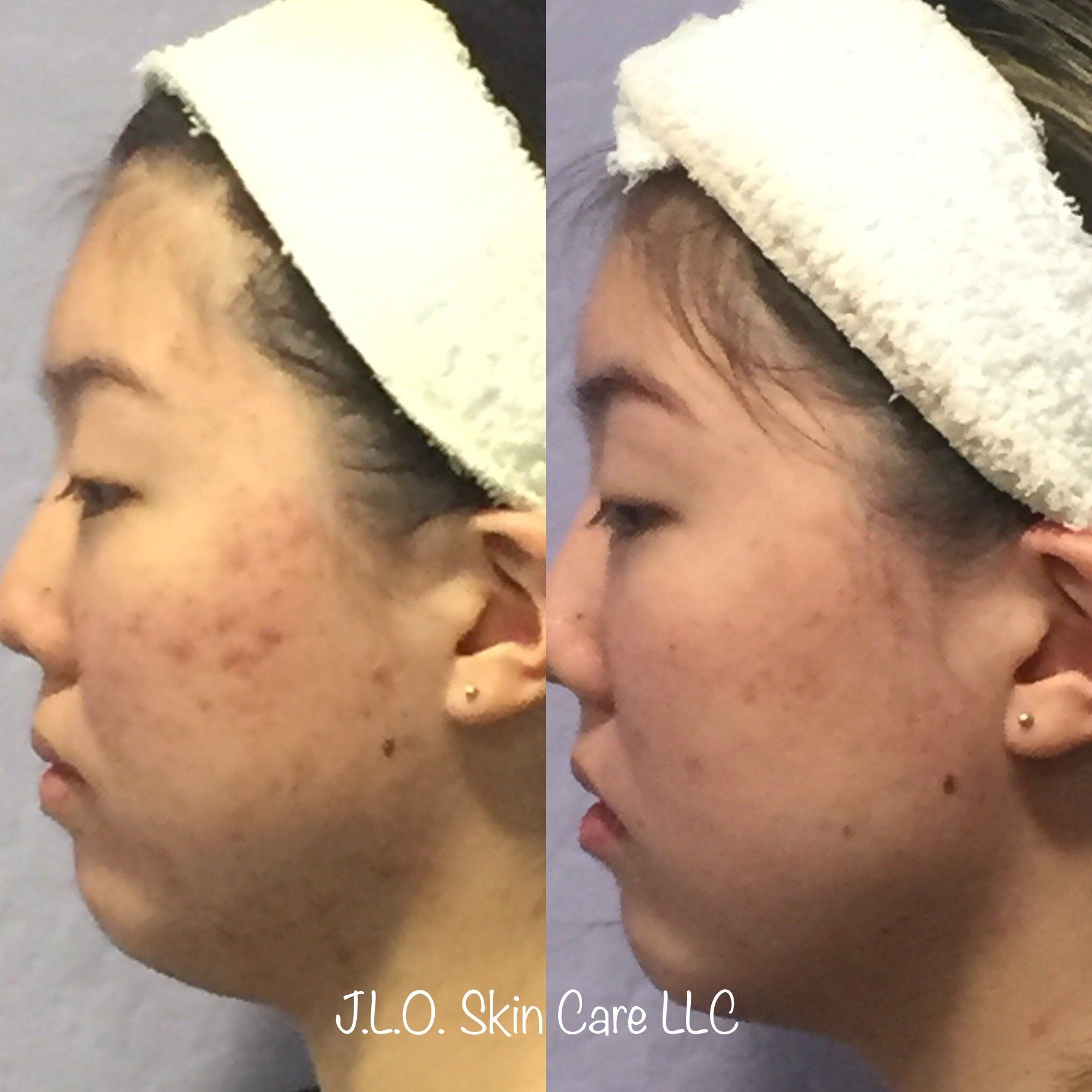 Before and after getting the Personalized Acne Program