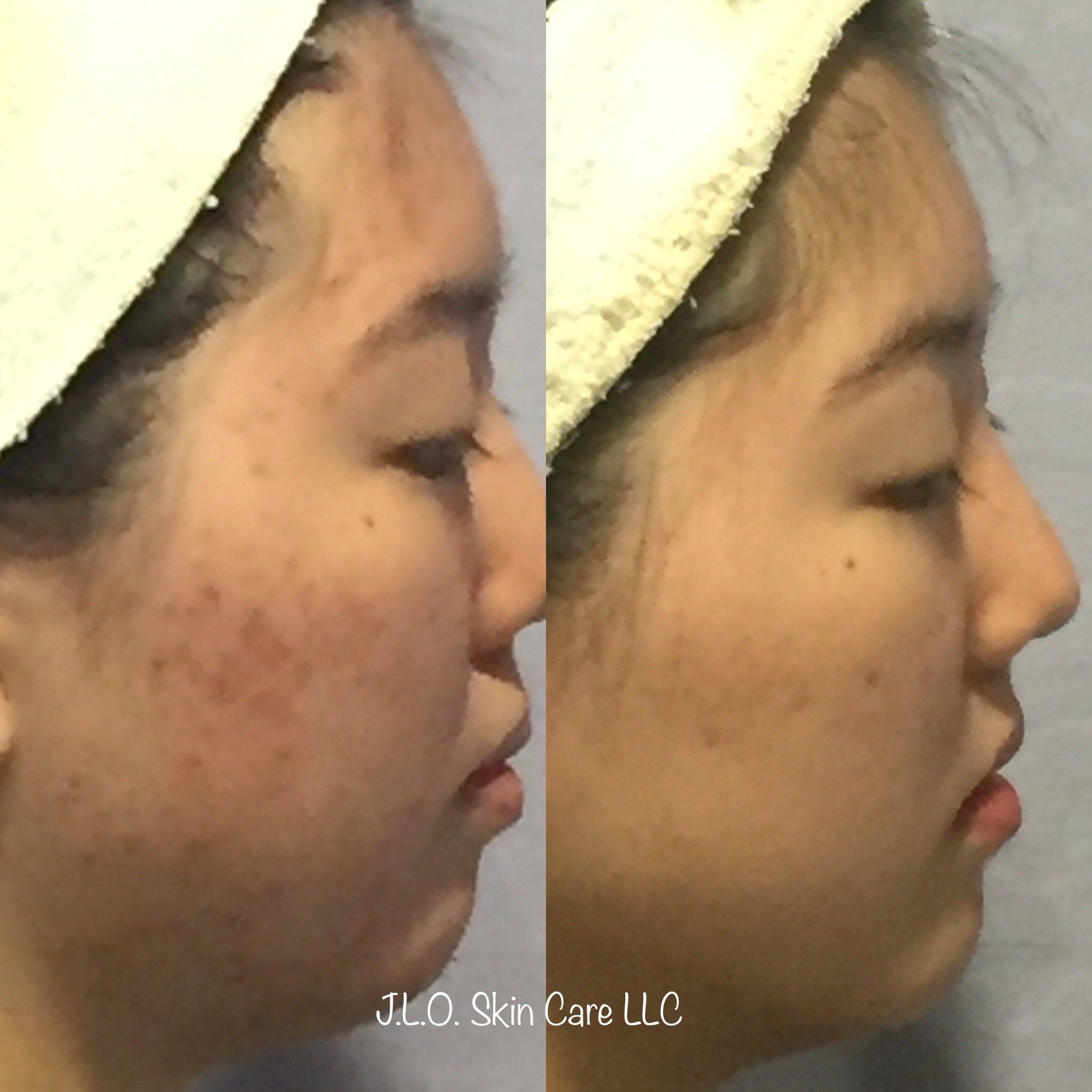 Before and after getting the Personalized Acne Program