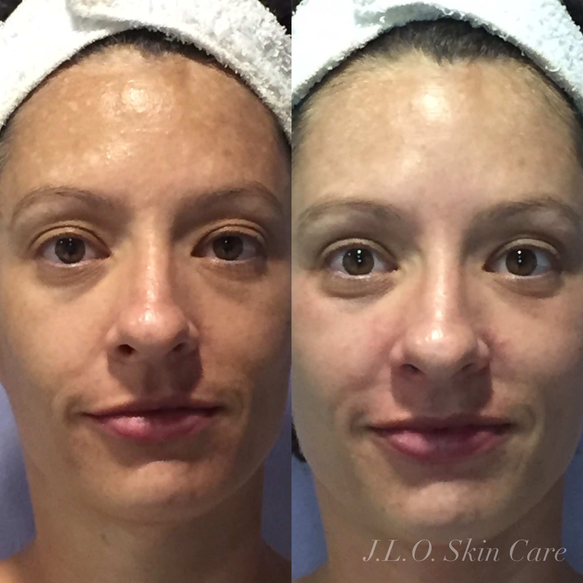 Before and after getting facial treatment