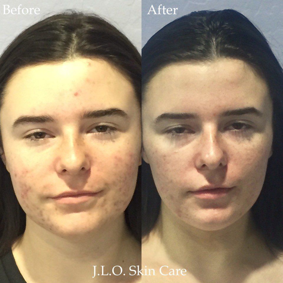 Before and after getting the Acne treatment