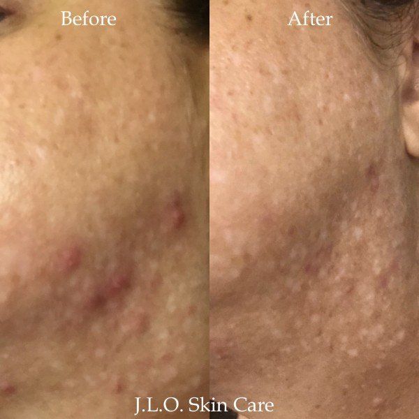 Before and after getting the Acne treatment