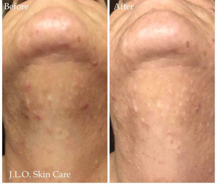Before and after getting the Acne treatment