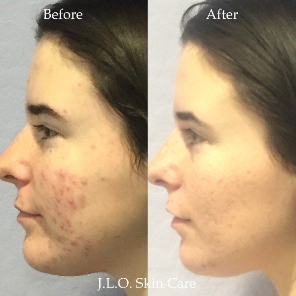 Before and after getting the Acne treatment