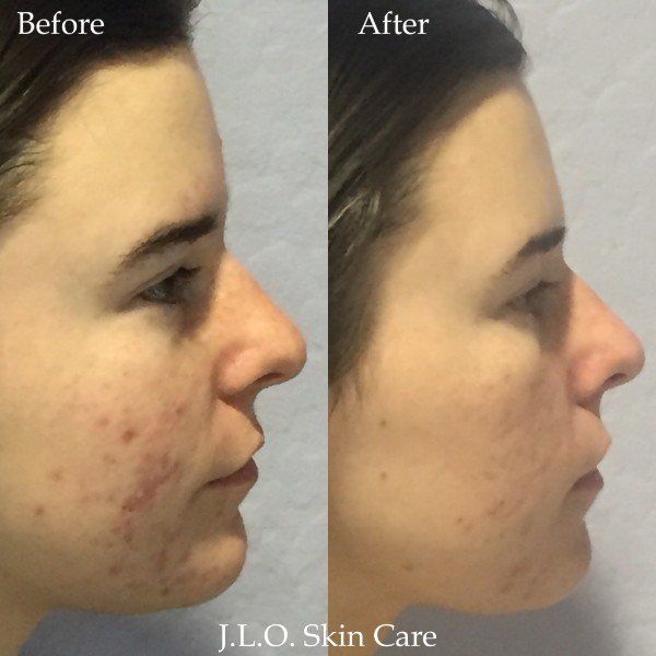 Before and after getting the Acne treatment