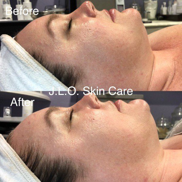 Before and after getting Microneedling Therapy
