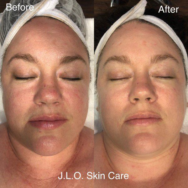 Before and after getting Microneedling Therapy