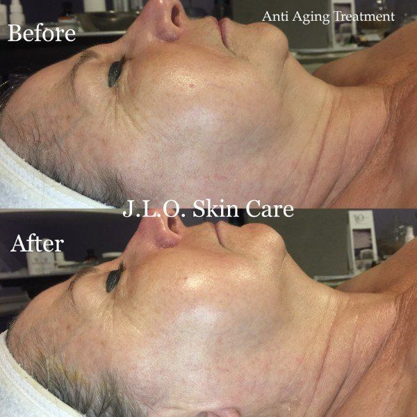 View of patient face before and after facial treatment
