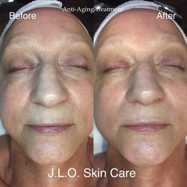 View of patient face before and after facial treatment