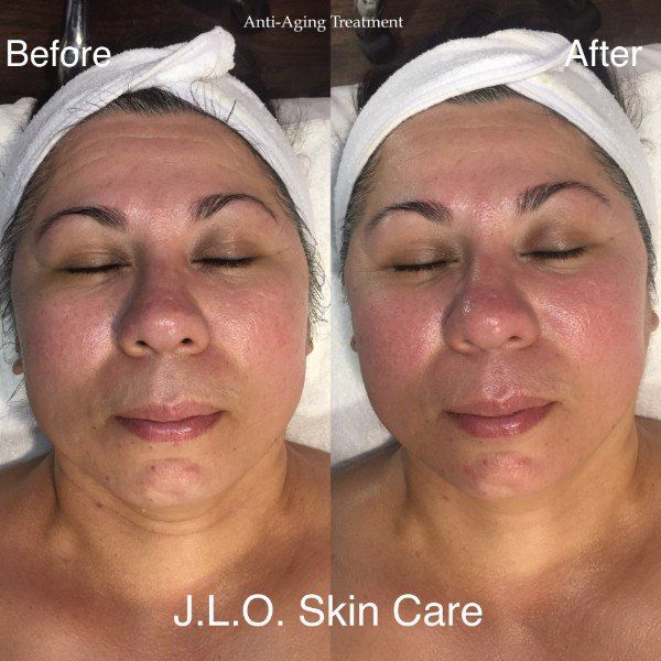 View of patient face before and after facial treatment