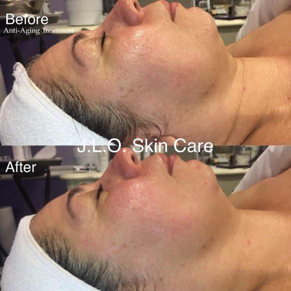 View of patient face before and after facial treatment
