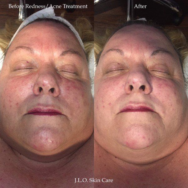 View of patient face before and after facial treatment