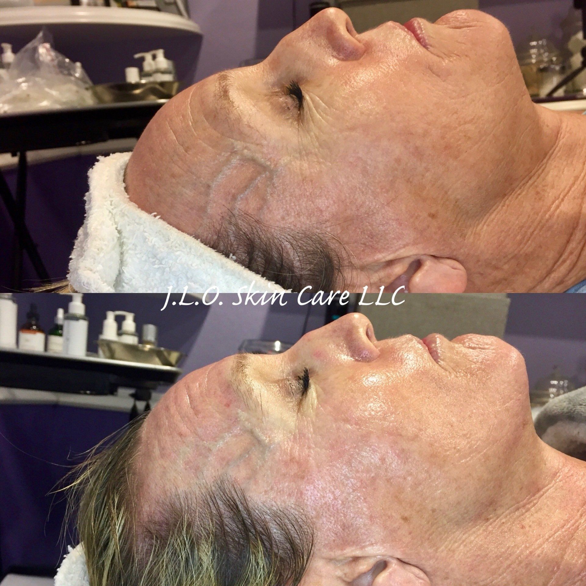 Before and after getting Microneedling Therapy