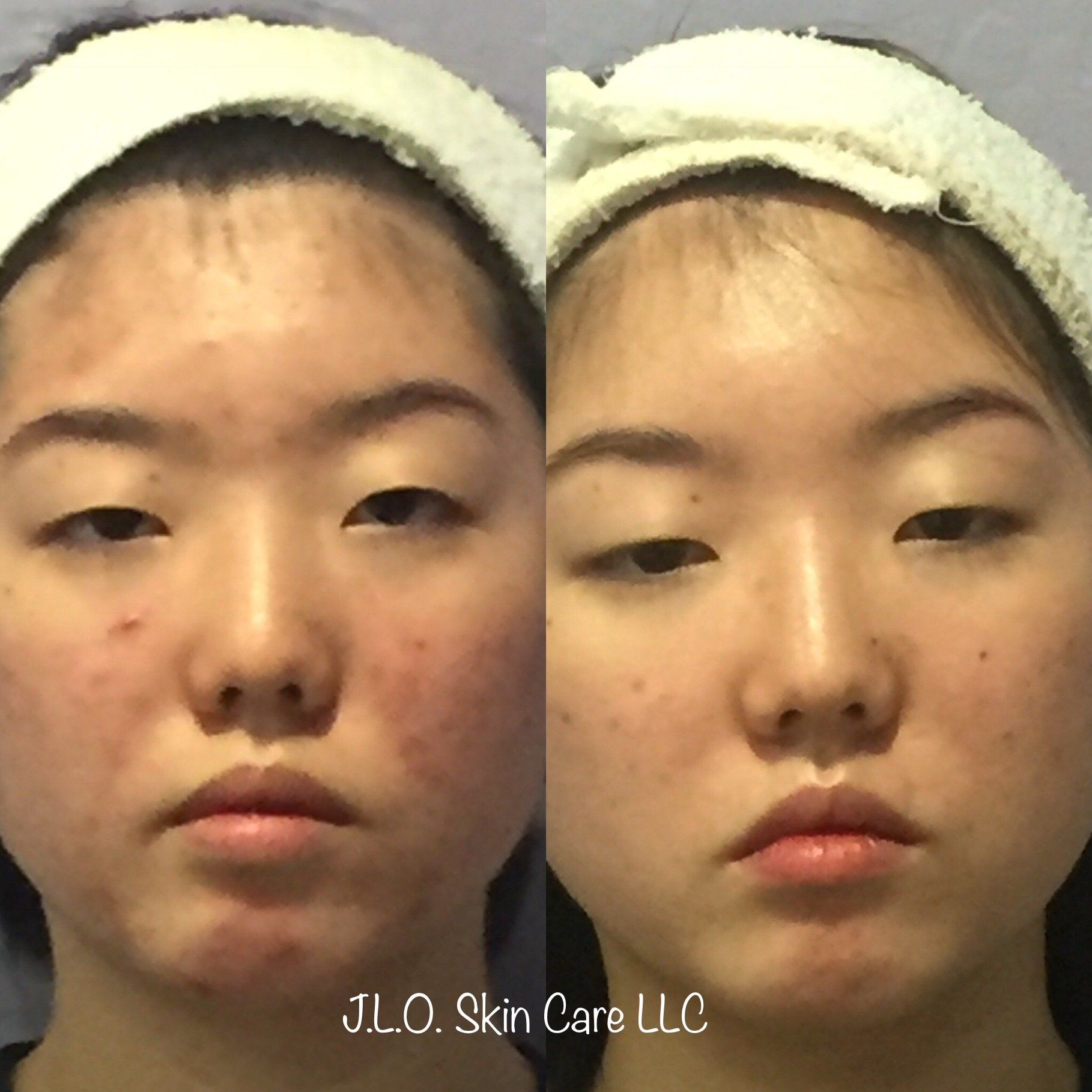Before and after getting the Acne treatment
