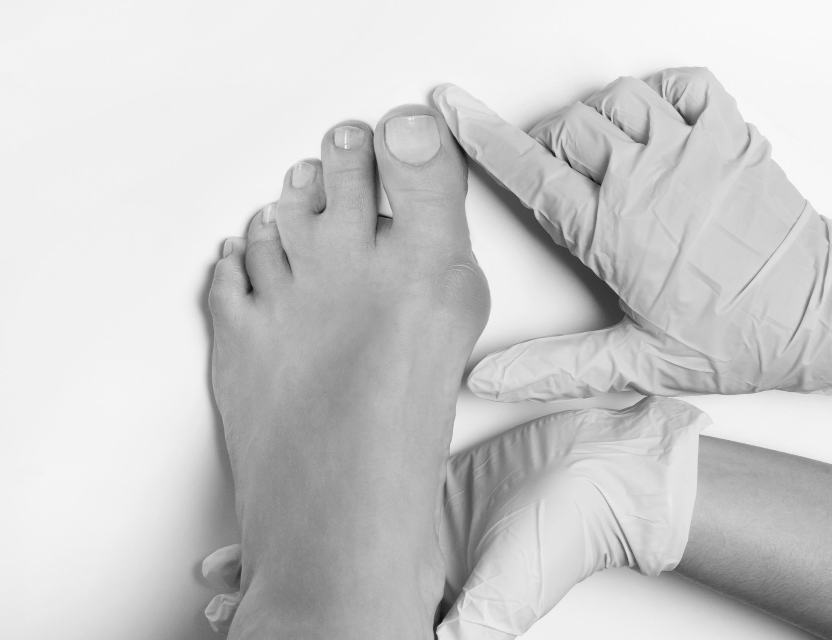 black and white close up photo of a podiatrist wearing gloves examining a bunion on the left foot.