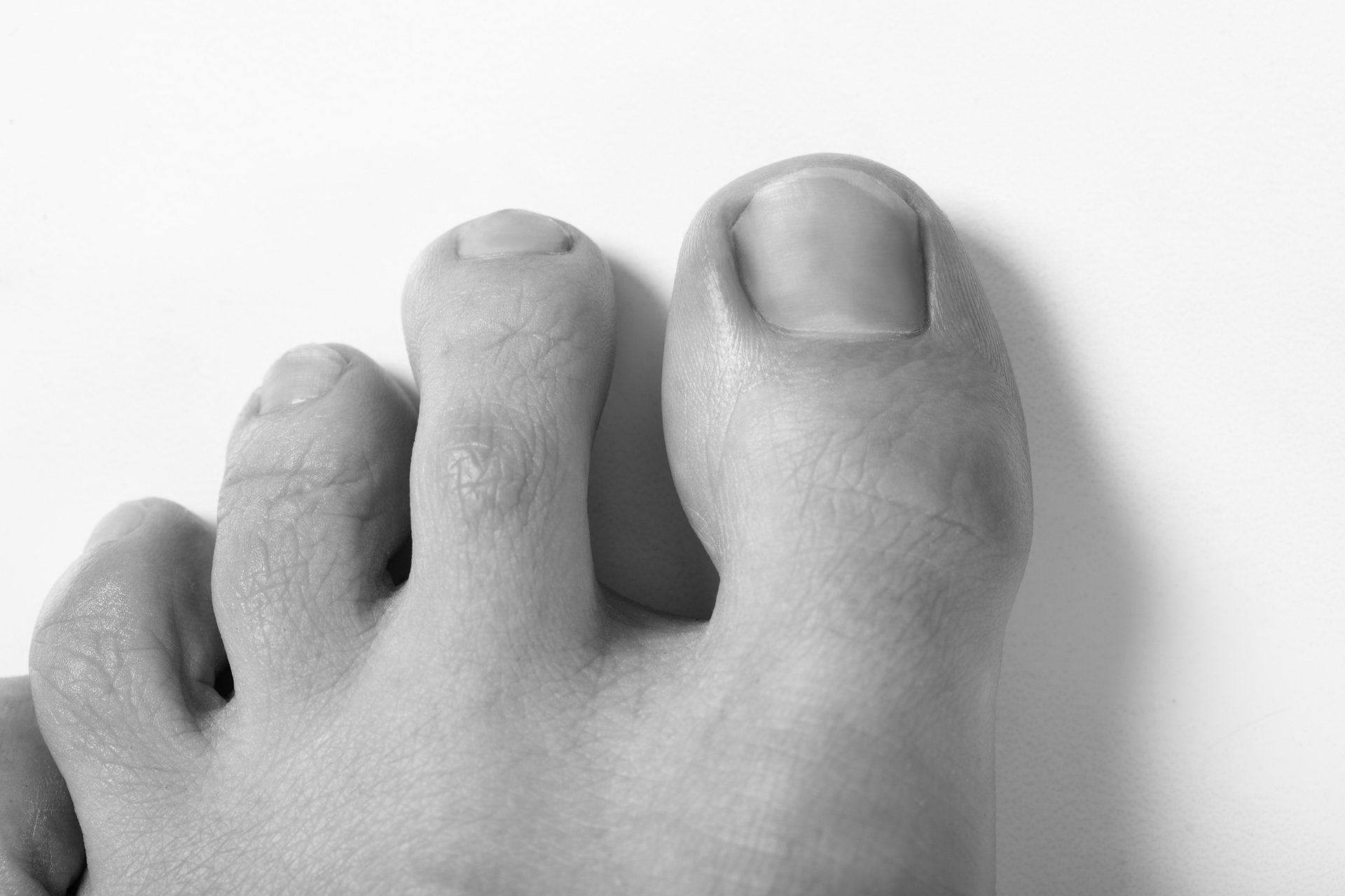 black and white photo of toes showing the big one swollen due to ingrown townails