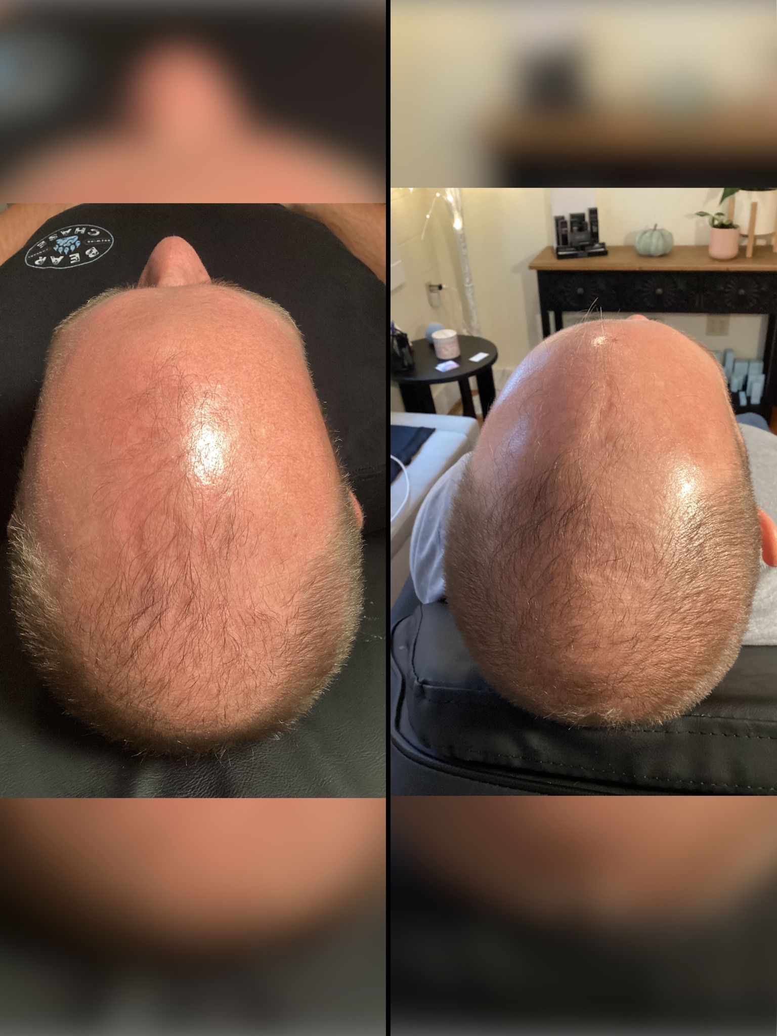 A man 's head is shown before and after a hair transplant.