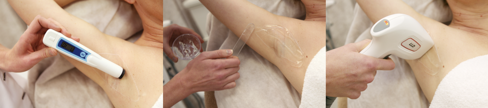Een vrouw krijgt een laserontharingsbehandeling op haar onderarm.