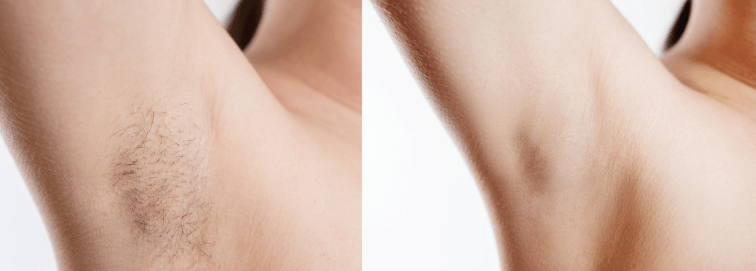 Een voor en na foto van de okselontharing van een vrouw.