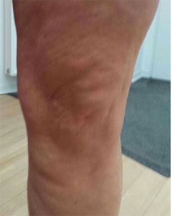 Un primo piano della gamba di una persona con vene varicose.