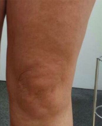 Un primo piano della gamba di una donna con vene varicose.