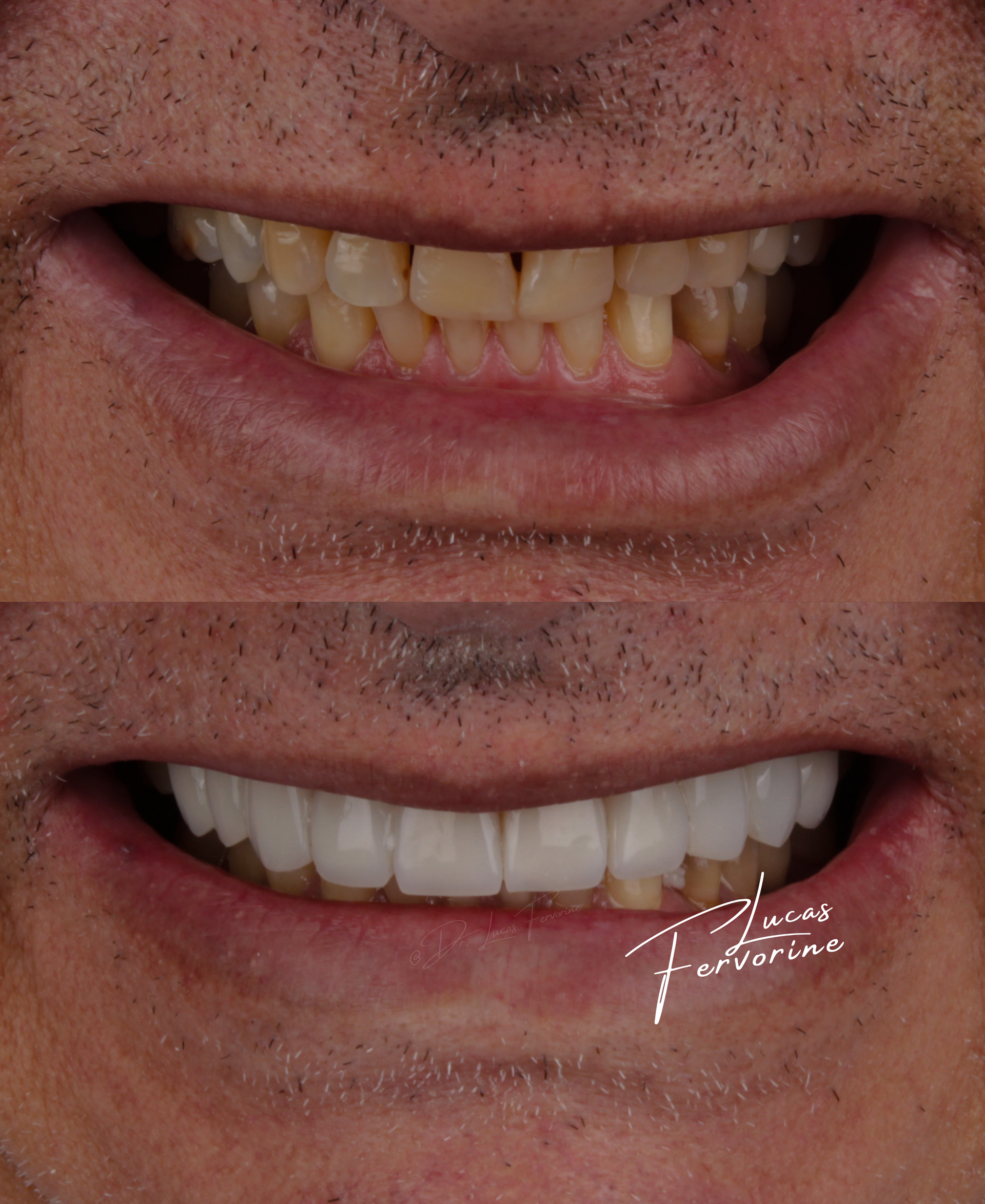 Implante Dentário e Reabilitação