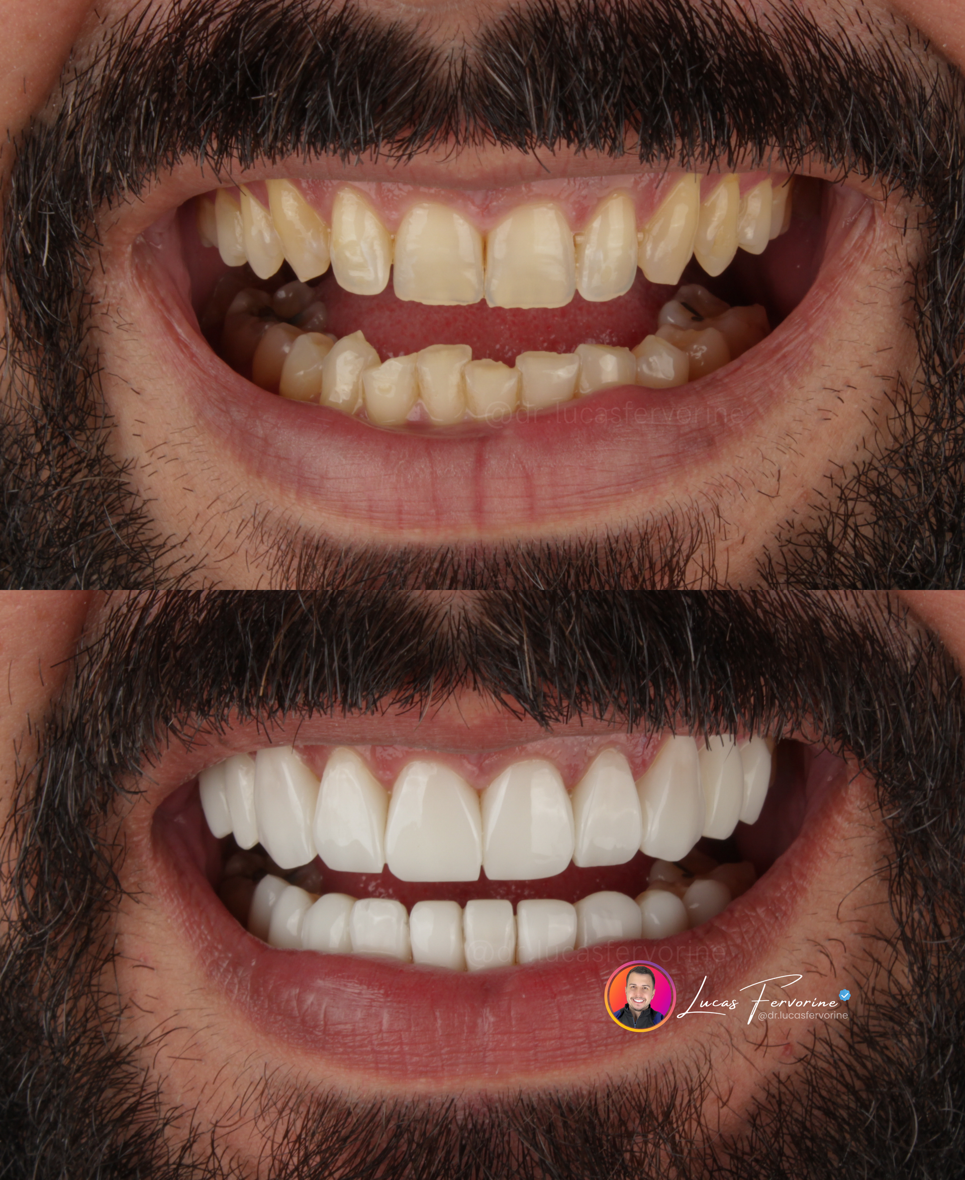 Lentes de Contato em Resina Composta