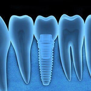 Dental implant x-ray — Family Dentistry in Castleton, NY