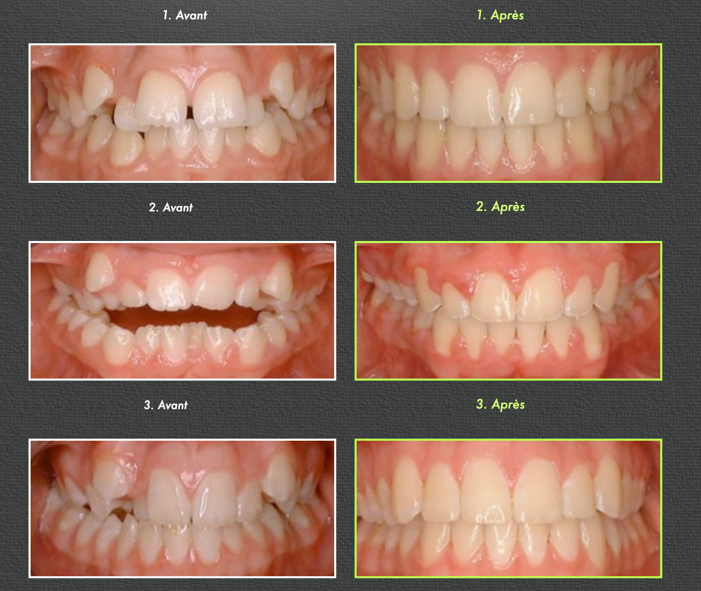 Comparison of before/after orthodontic treatment: misaligned teeth (left) vs. straight teeth (right).
